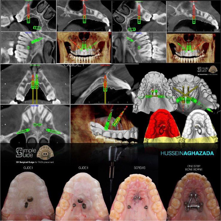 Ancoraggio scheletrico CBCT