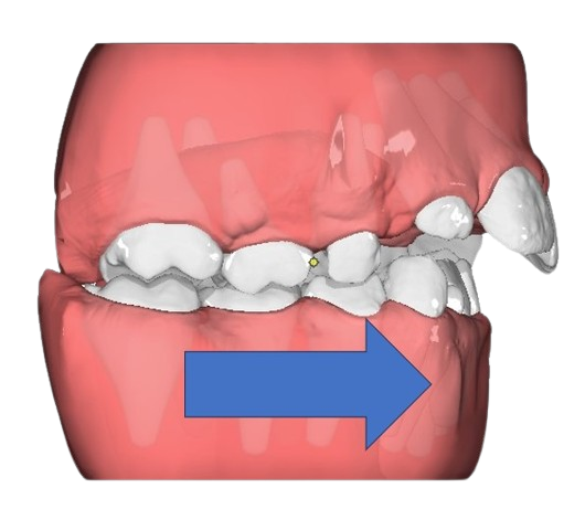 Simulazione digitale laterale degli spostamenti programmati in un trattamento elastodontico personalizzato
