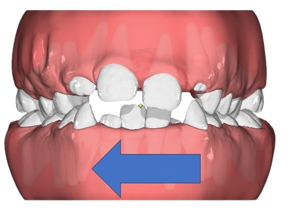 Simulazione digitale frontale degli spostamenti programmati in un trattamento elastodontico personalizzato