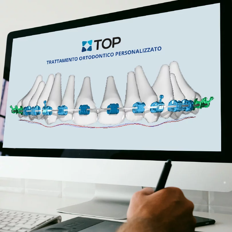 Bonding indiretto digitale: precisione, tempi e vantaggi reali per lo studio ortodontico 1 Progettazione digitale del posizionamento dei bracket con sistema TOP su monitor
